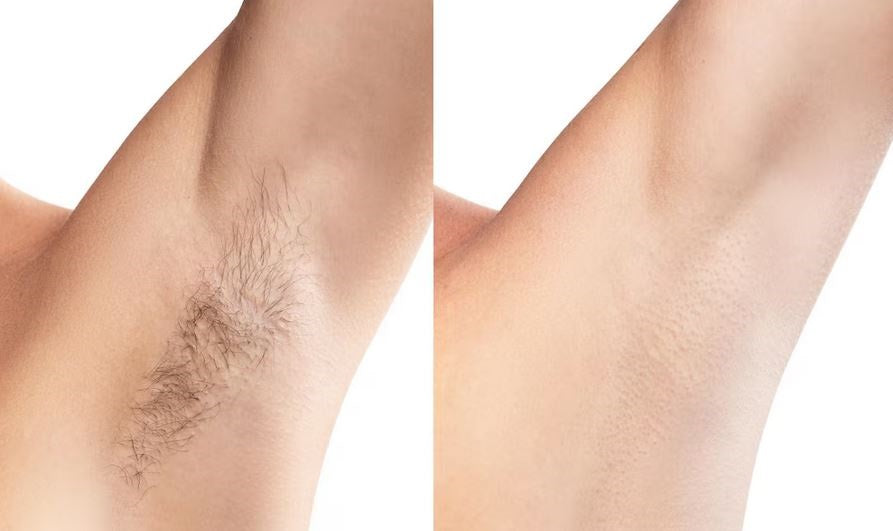 IPL Hair Remover