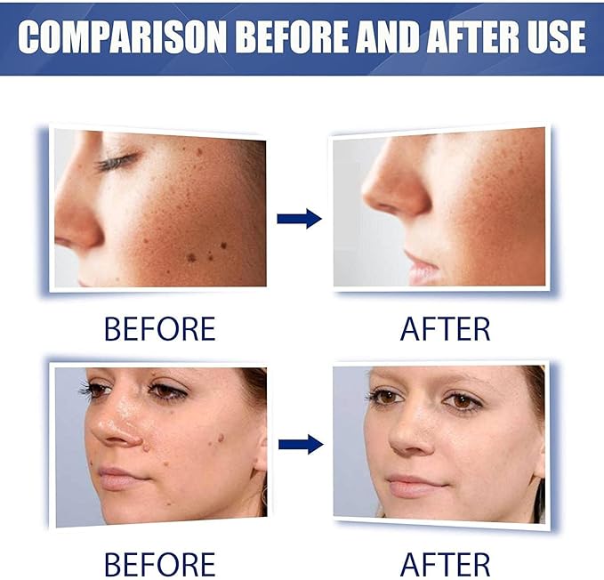 Warts Remover