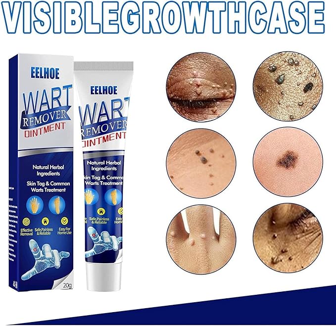 Warts Remover
