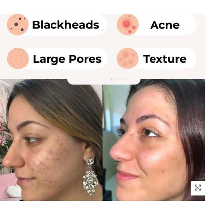 Acne remover household Pore Cleaner