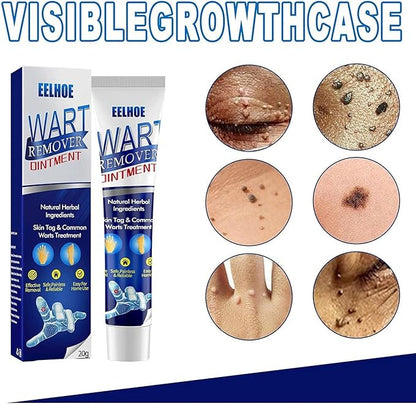 Warts Remover